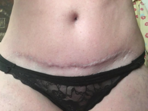 jo harrison, scar cover up tattoo